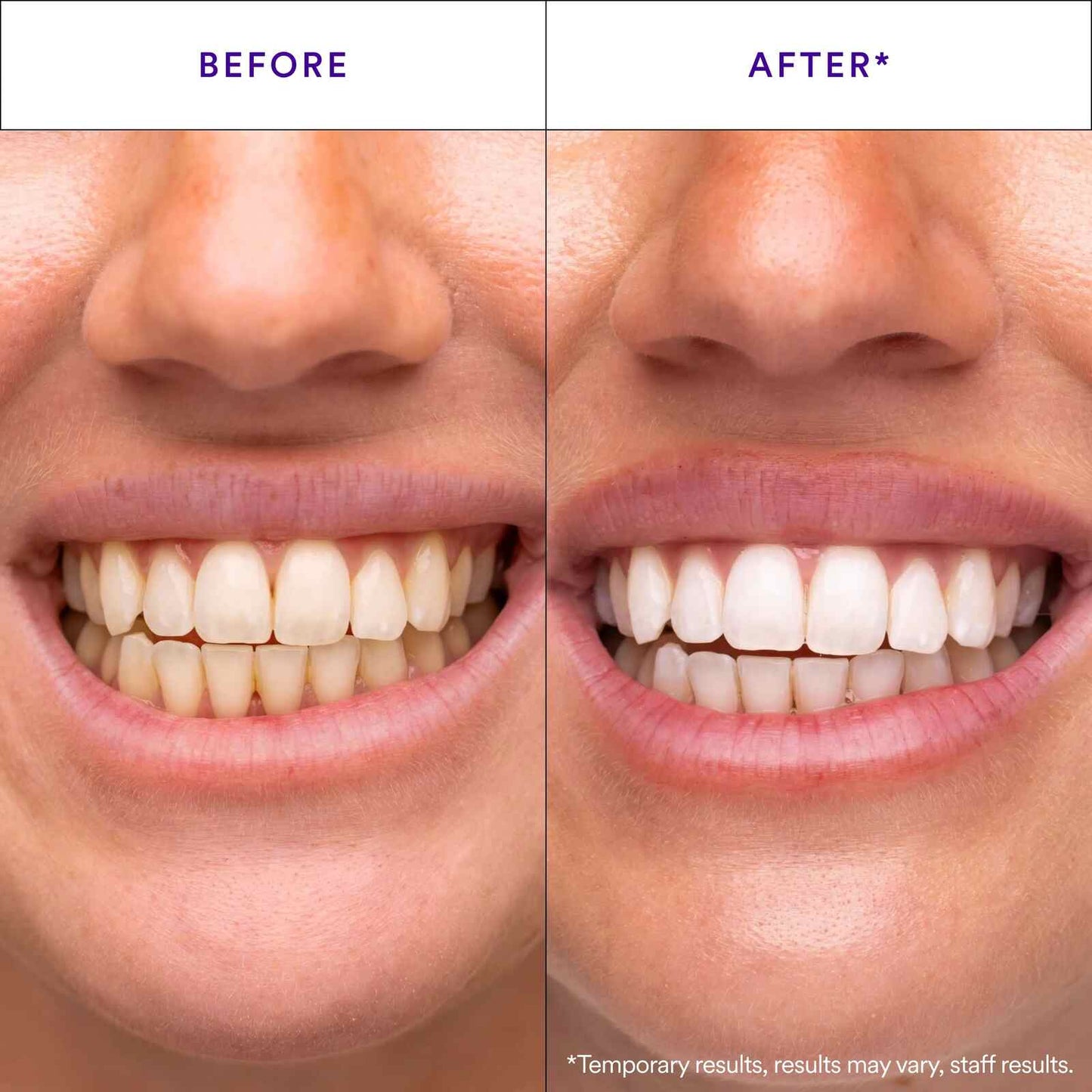 [BUY 1 GET 1 FREE] Stain-Lifting Purple Whitening Strips