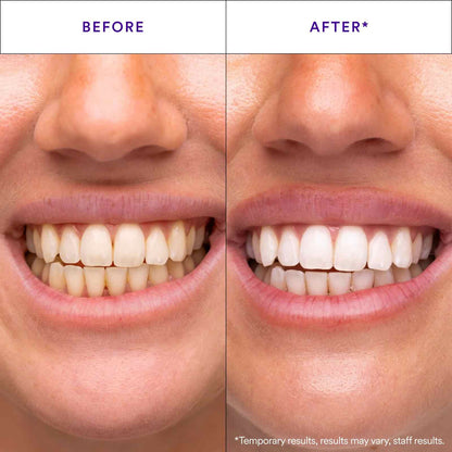 [BUY 1 GET 1 FREE] Stain-Lifting Purple Whitening Strips