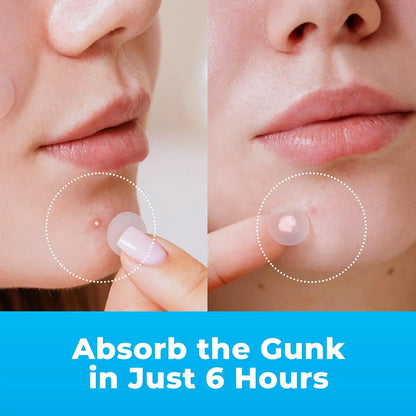 Overnight Blemish Clearing Hydrocolloid Acne Patches