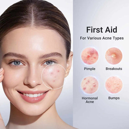 Rapid Acne Drying Lotion – Overnight Pimple & Body Treatment