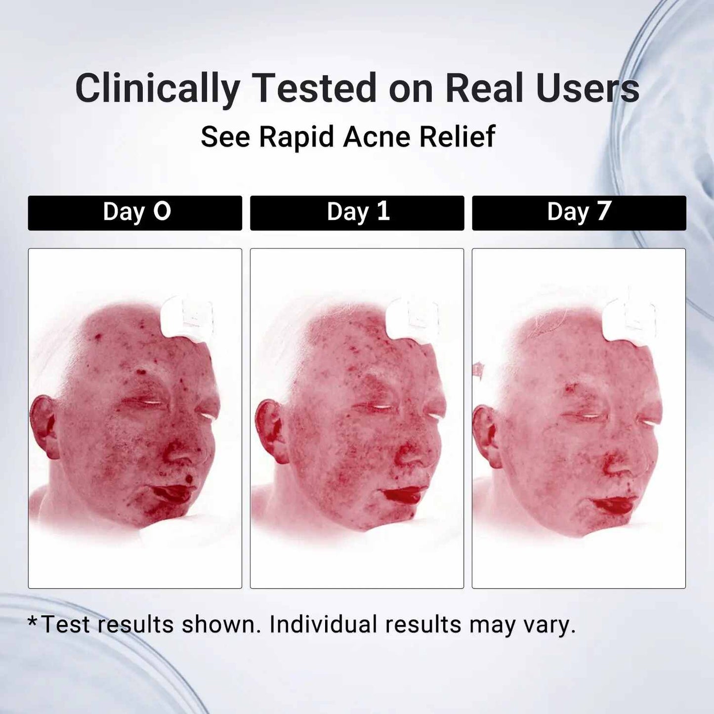 Rapid Acne Drying Lotion – Overnight Pimple & Body Treatment