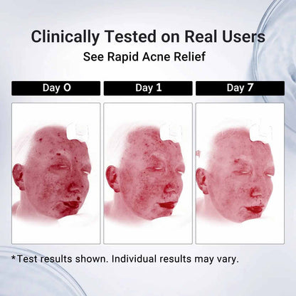 Rapid Acne Drying Lotion – Overnight Pimple & Body Treatment