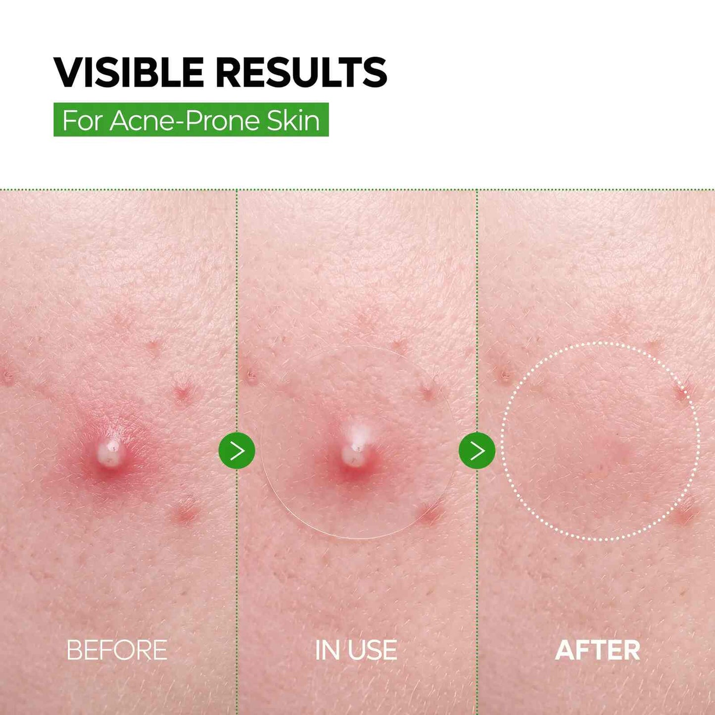 Blemish & Dark Spot Invisible Patch Duo