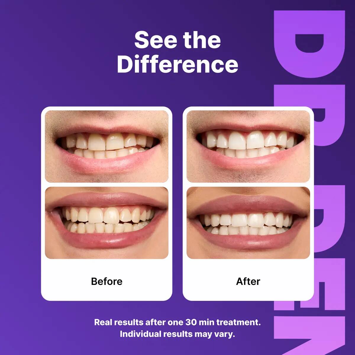Peroxide-Free Purple Teeth Whitening Strips