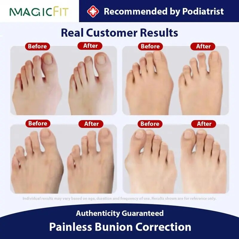 [BUY 1 GET 1 FREE] Silicone Toe Separators for Bunion Relief