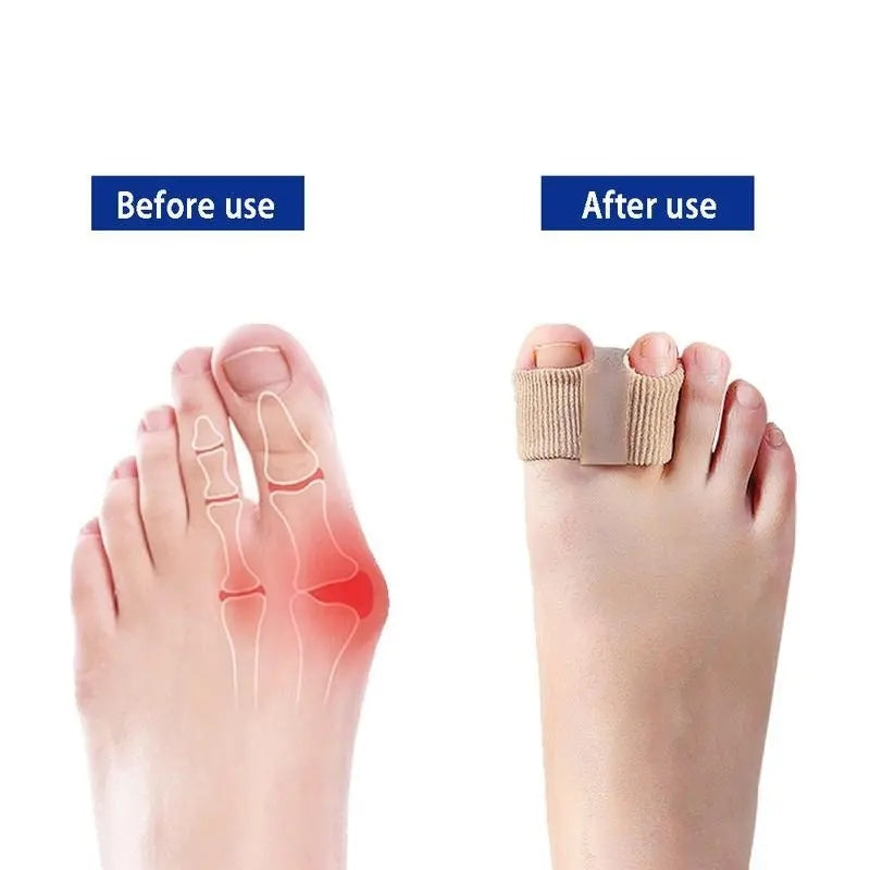 [BUY 1 GET 1 FREE] Silicone Toe Separators for Bunion Relief